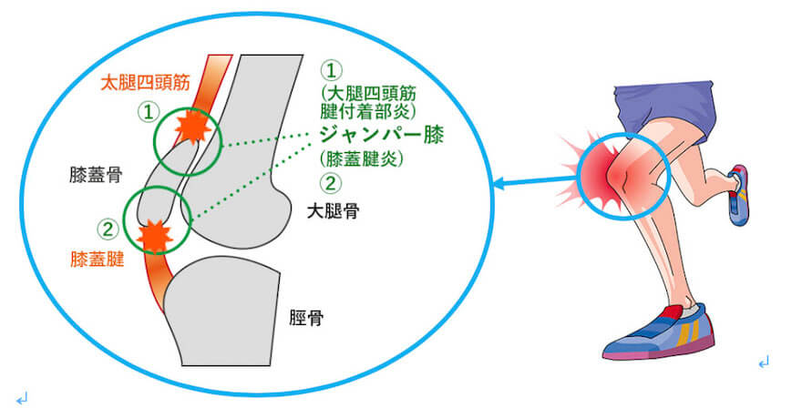 ジャンパー膝