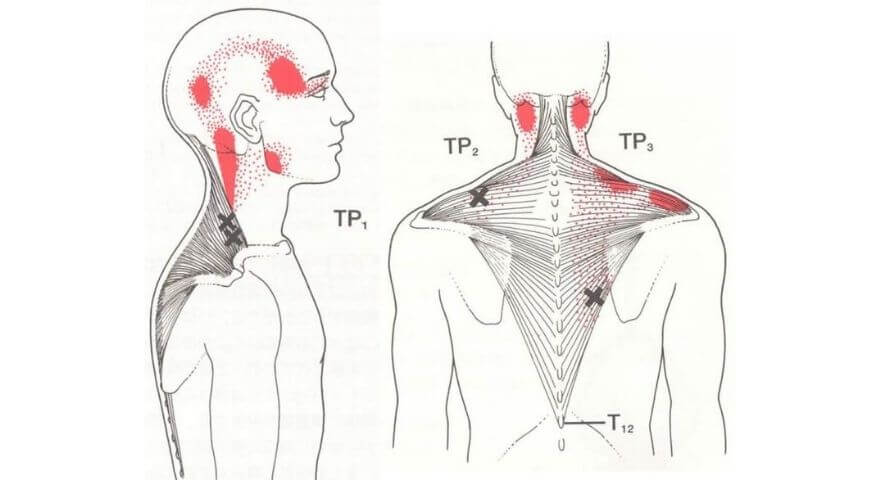 僧帽筋トリガーポイント
