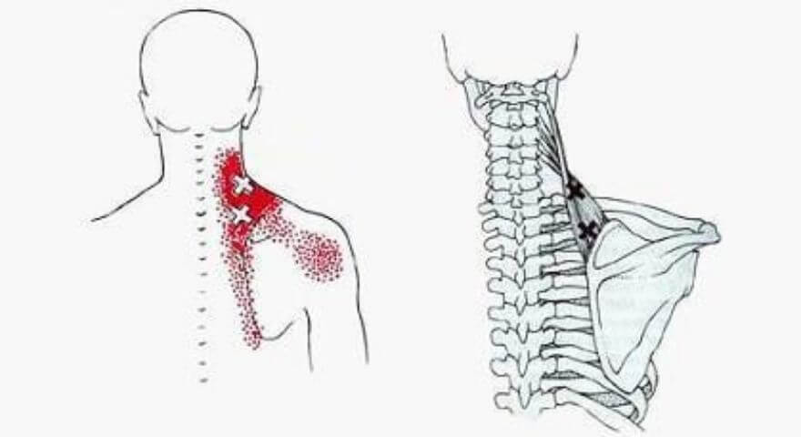 肩甲挙筋のトリガーポイント