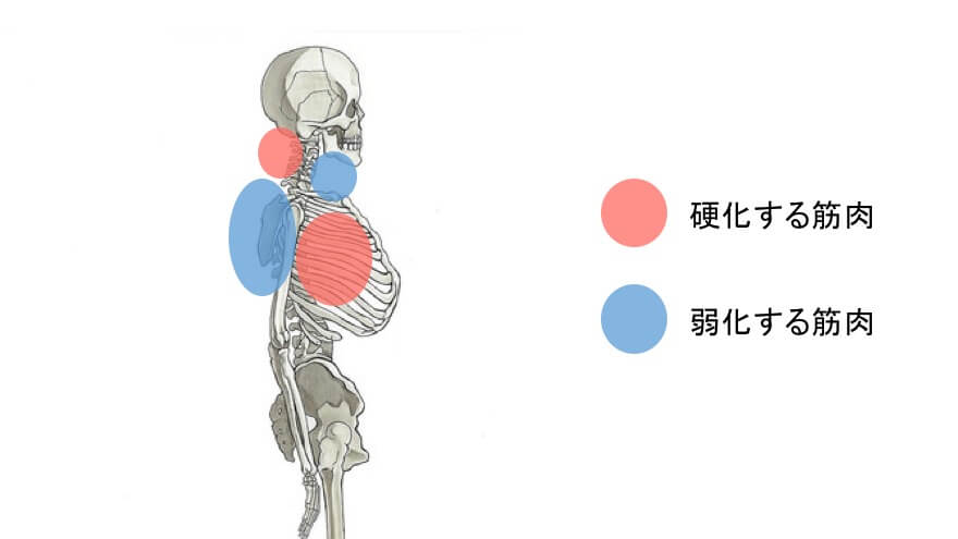 上位交差性障害